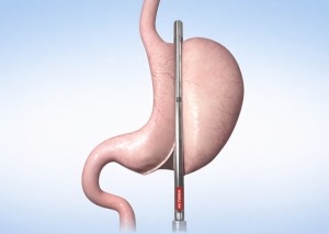 Our Services - Bariatric Surgery - Dr. Nainesh Patel